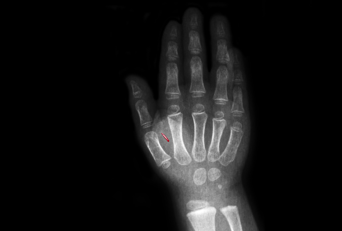 Tomografie einer gechipten Hand