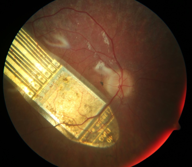 Retina-Implantat